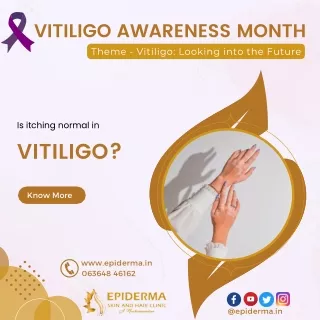 Is itching normal in Vitiligo | Best Skin Clinic in Jayanagar | Epiderma Clinic