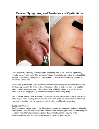 Causes, Symptoms, and Treatments of Cystic Acne - DMK