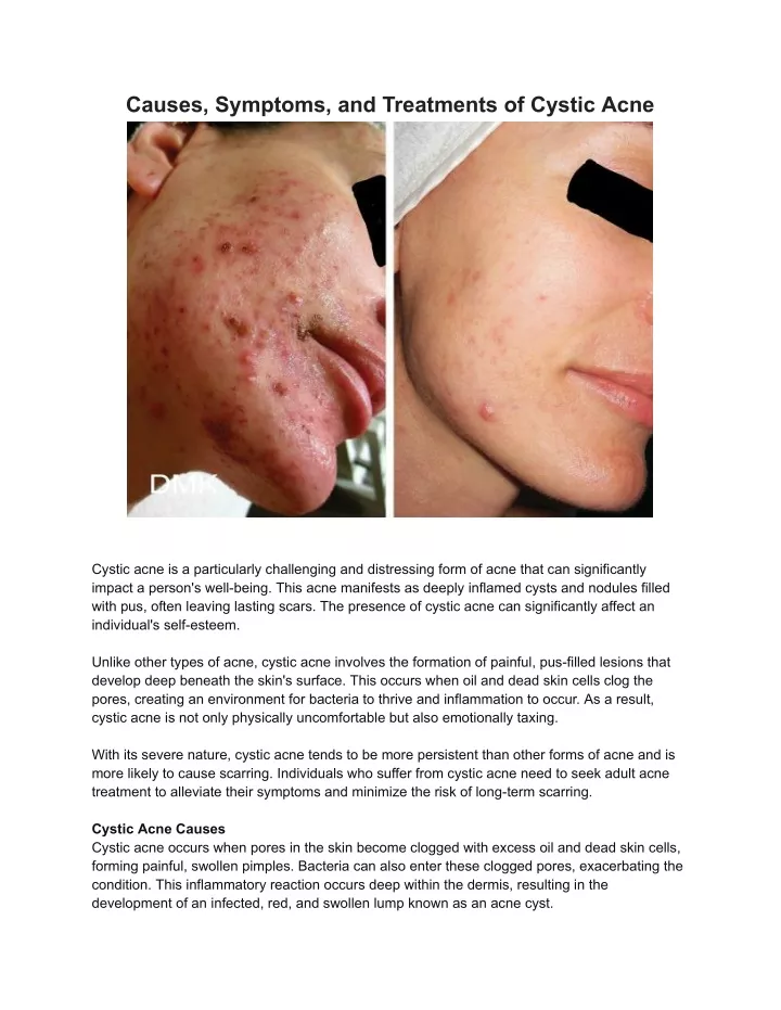 causes symptoms and treatments of cystic acne