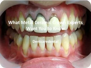 What Metal Ceramic Crown Experts Want You to Know