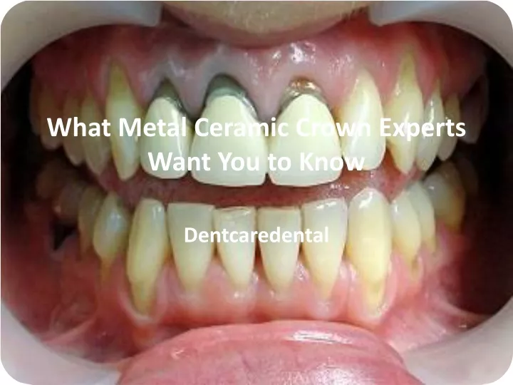 what metal ceramic crown experts want you to know