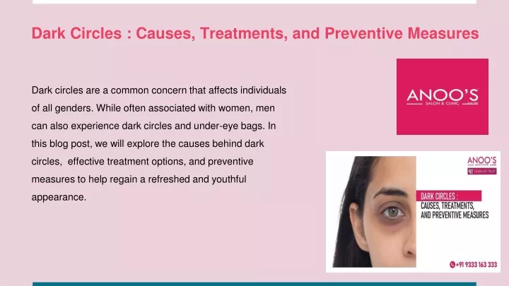 dark circles causes treatments and preventive measures