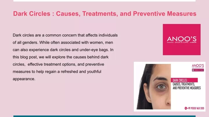 dark circles causes treatments and preventive