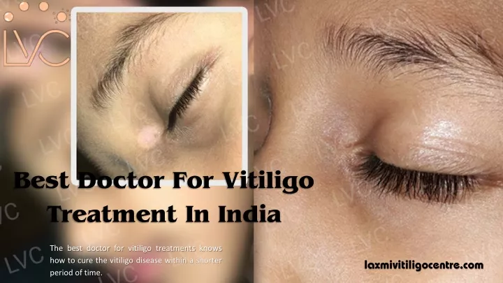 best doctor for vitiligo treatment in india
