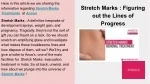 Stretch Marks Treatment - slide 1