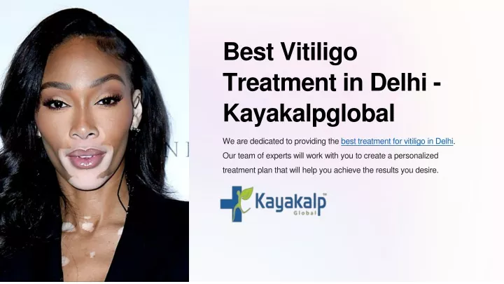 best vitiligo treatment in delhi kayakalpglobal