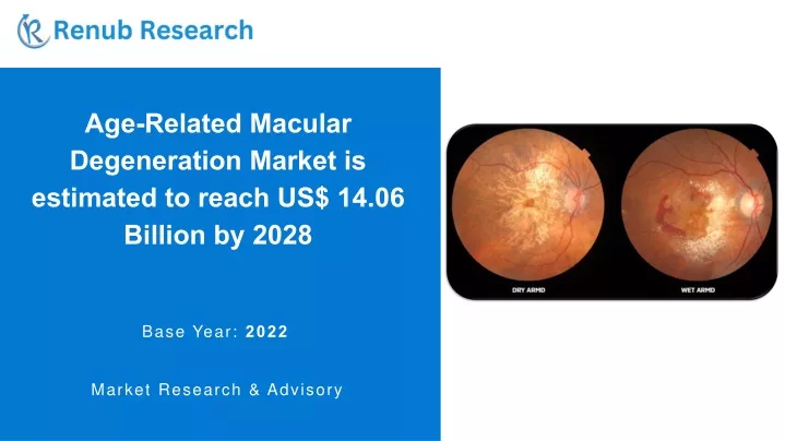 age related macular degeneration market