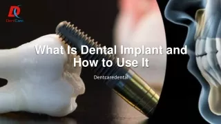 What Is Dental Implant and How to Use