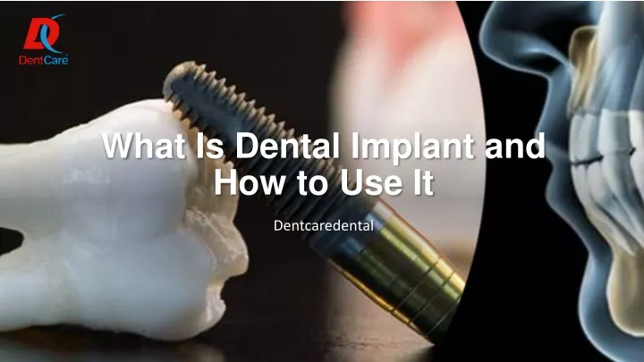 what is dental implant and how to use it