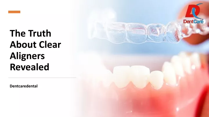 the truth about clear aligners revealed