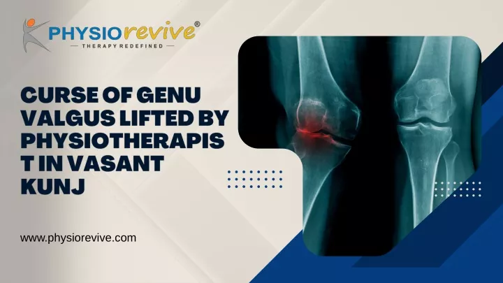 curse of genu valgus lifted by physiotherapist