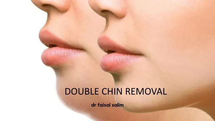 double chin removal