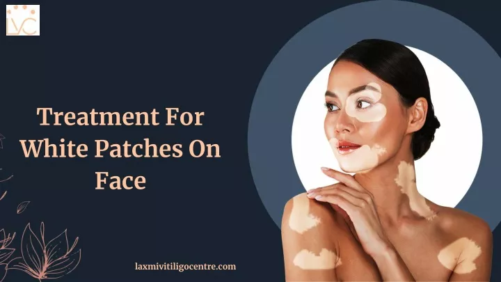 treatment for white patches on face