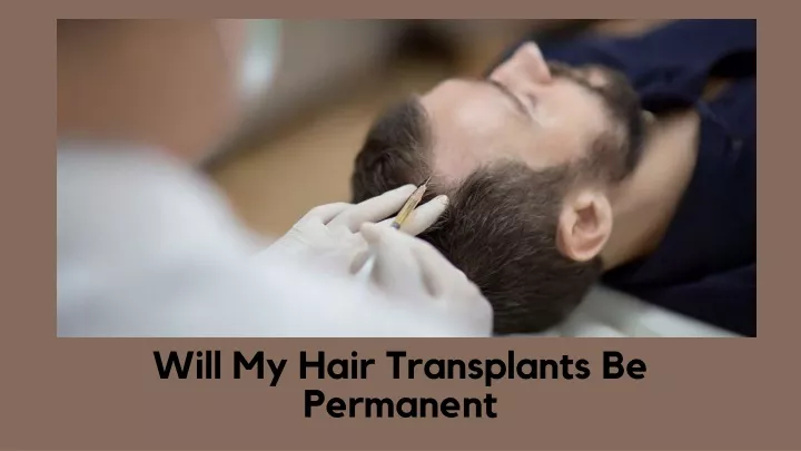 will my hair transplants be permanent