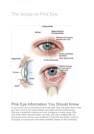 The Scoop on Pink Eye