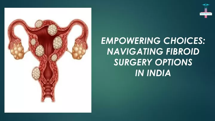 empowering choices navigating fibroid surgery