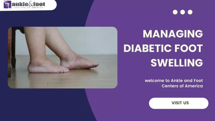 managing diabetic foot swelling