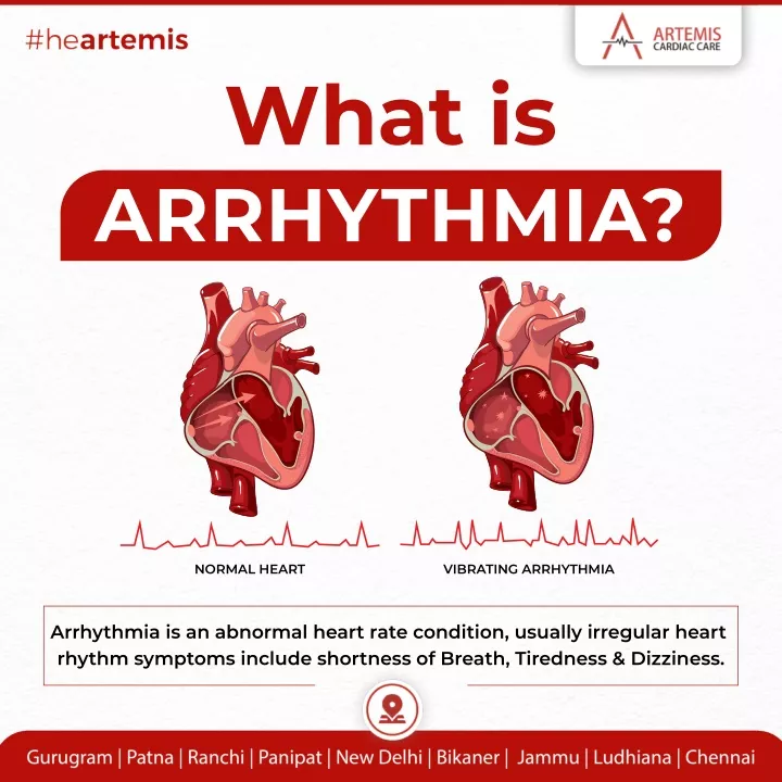 what is arrhythmia