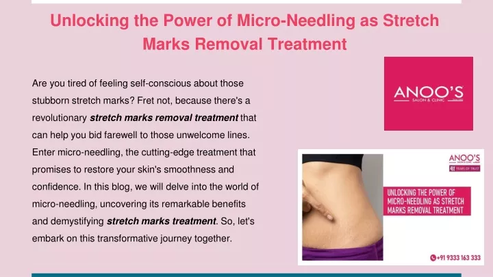 unlocking the power of micro needling as stretch marks removal treatment