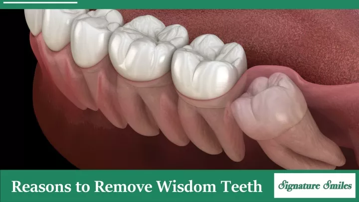 reasons to remove wisdom teeth