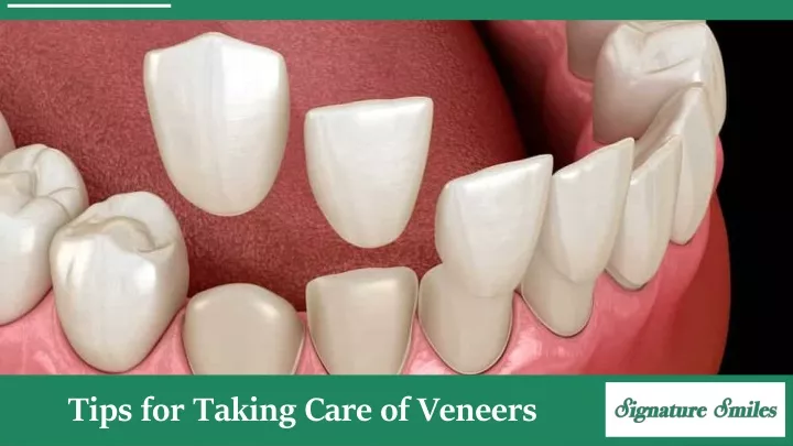 tips for taking care of veneers