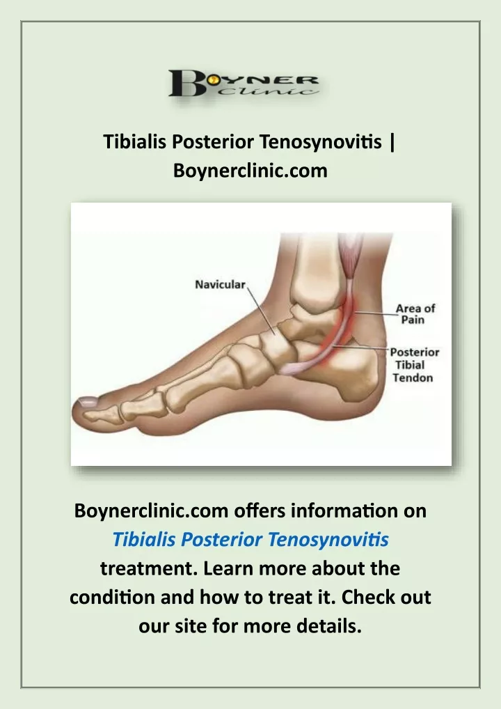 tibialis posterior tenosynovitis boynerclinic com