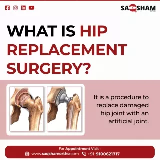 The Ultimate Guide to Hip Replacement Surgery