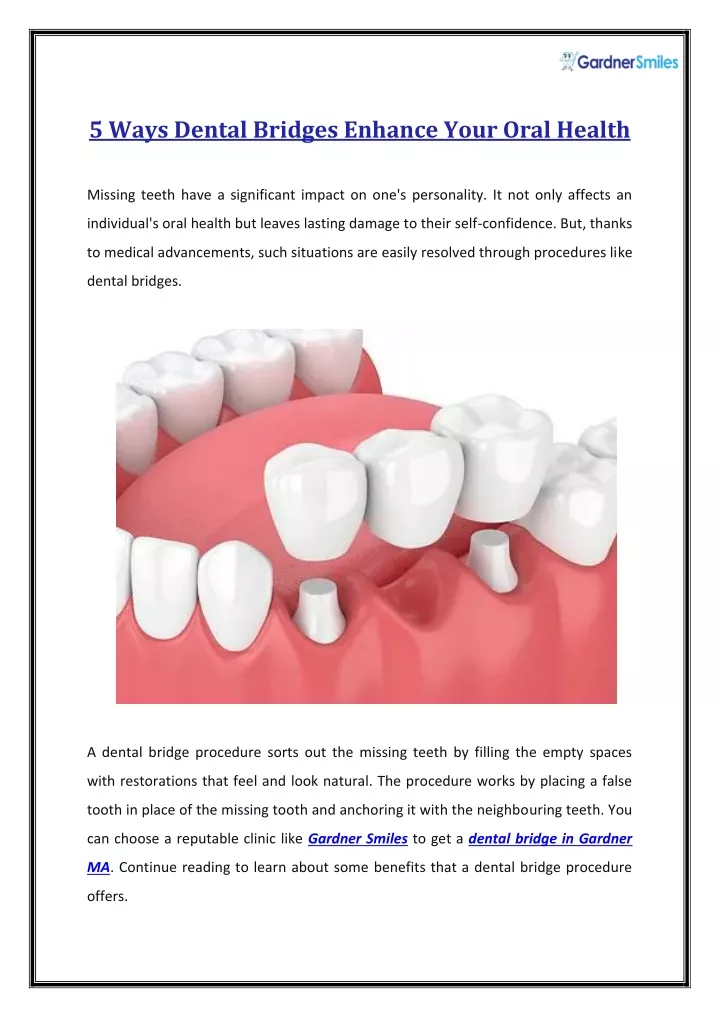 5 ways dental bridges enhance your oral health