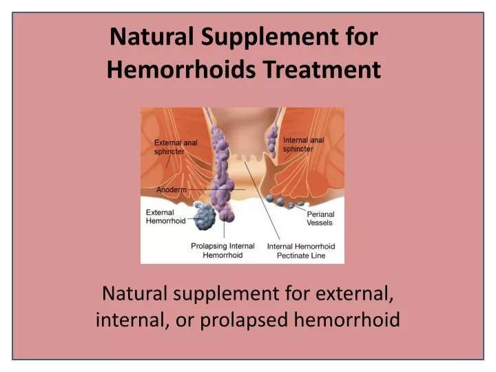 natural supplement for hemorrhoids treatment