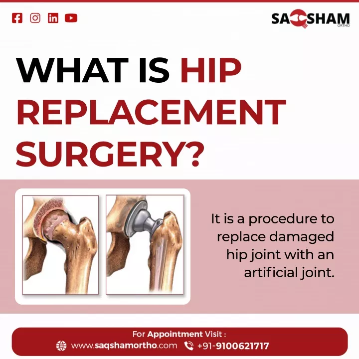 what is hip replacement surgery