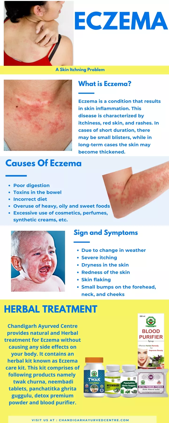 eczema