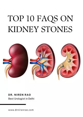 Top 10 FAQs on Kidney Stones
