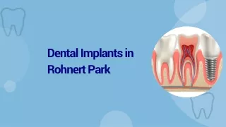 Dental Implants in Rohnert Park: Your Path to a Confident Smile!