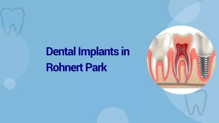 dental implants in rohnert park