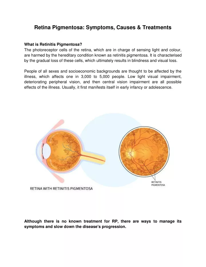 retina pigmentosa symptoms causes treatments