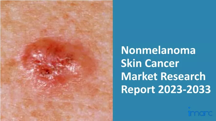 nonmelanoma skin cancer market research report 2023 2033
