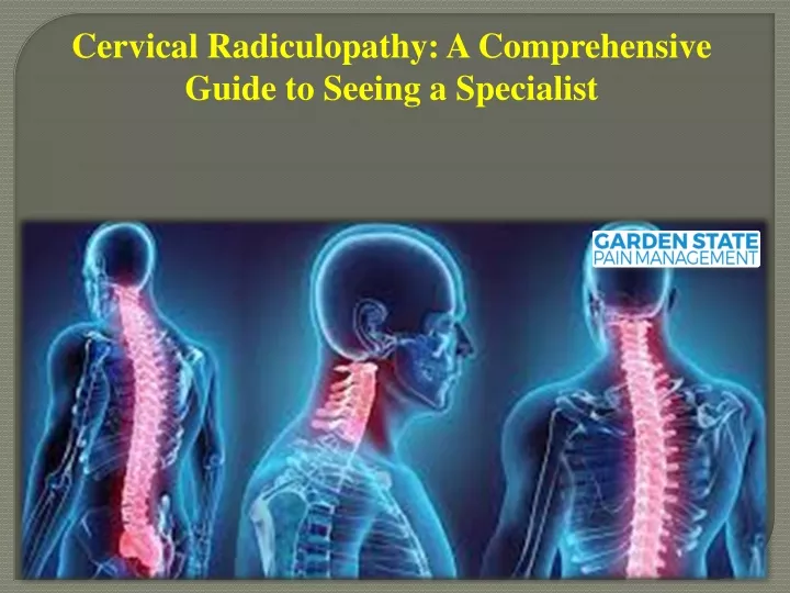 cervical radiculopathy a comprehensive guide