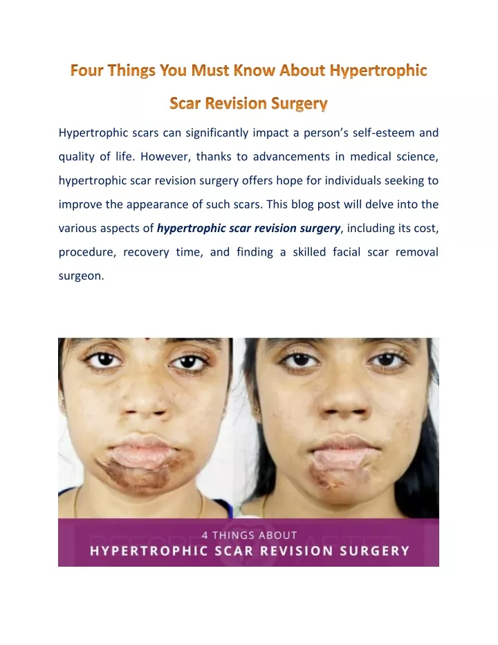 hypertrophic scars can significantly impact