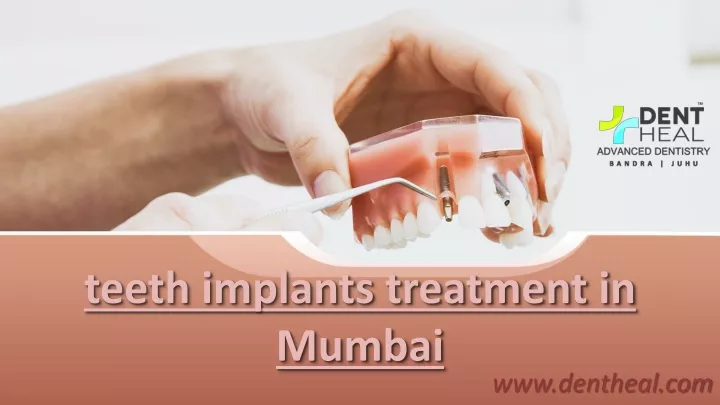 teeth implants treatment in mumbai