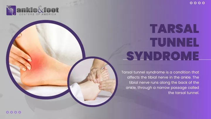 tarsal tunnel syndrome