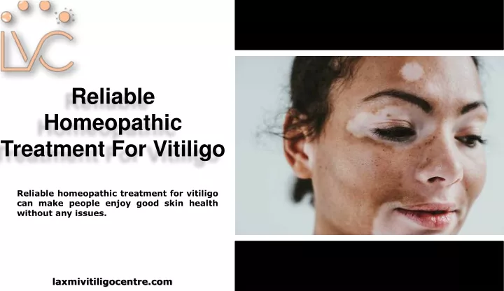 reliable homeopathic treatment for vitiligo