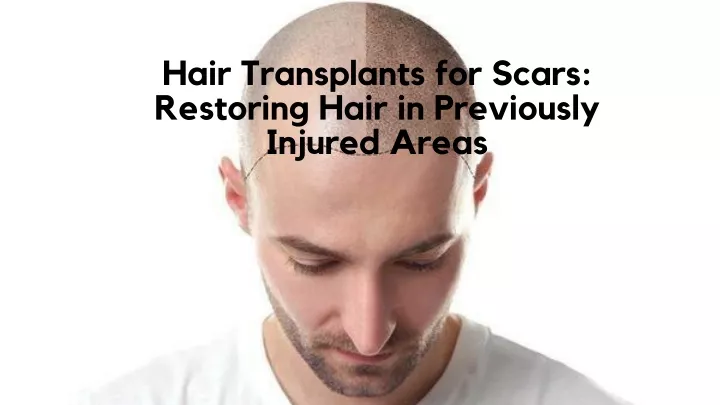 hair transplants for scars restoring hair