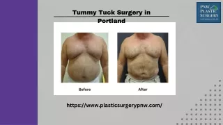 Get the Best Tummy Tuck Surgery in Portland