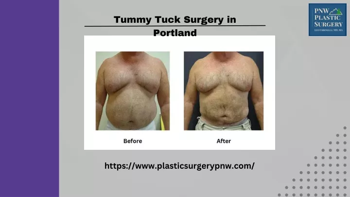 tummy tuck surgery in portland