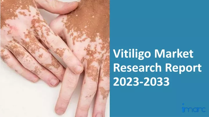 latest research in vitiligo treatment 2023