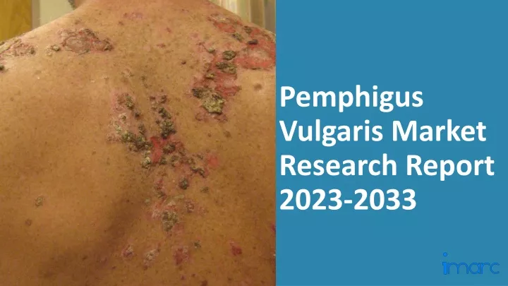 pemphigus vulgaris market research report 2023 2033