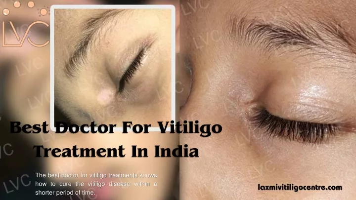 best doctor for vitiligo treatment in india