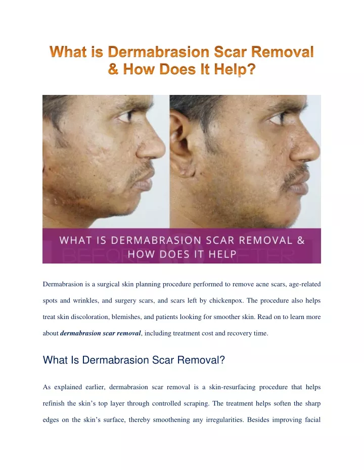 dermabrasion is a surgical skin planning