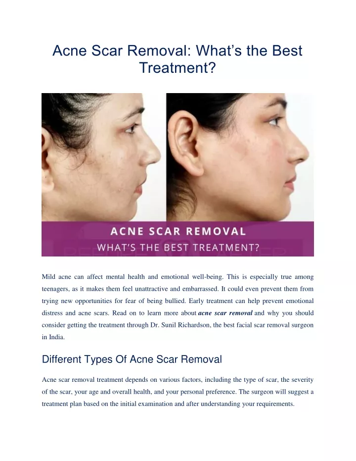 acne scar removal what s the best treatment
