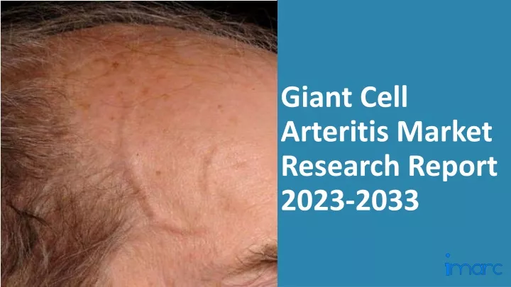 giant cell arteritis market research report 2023 2033